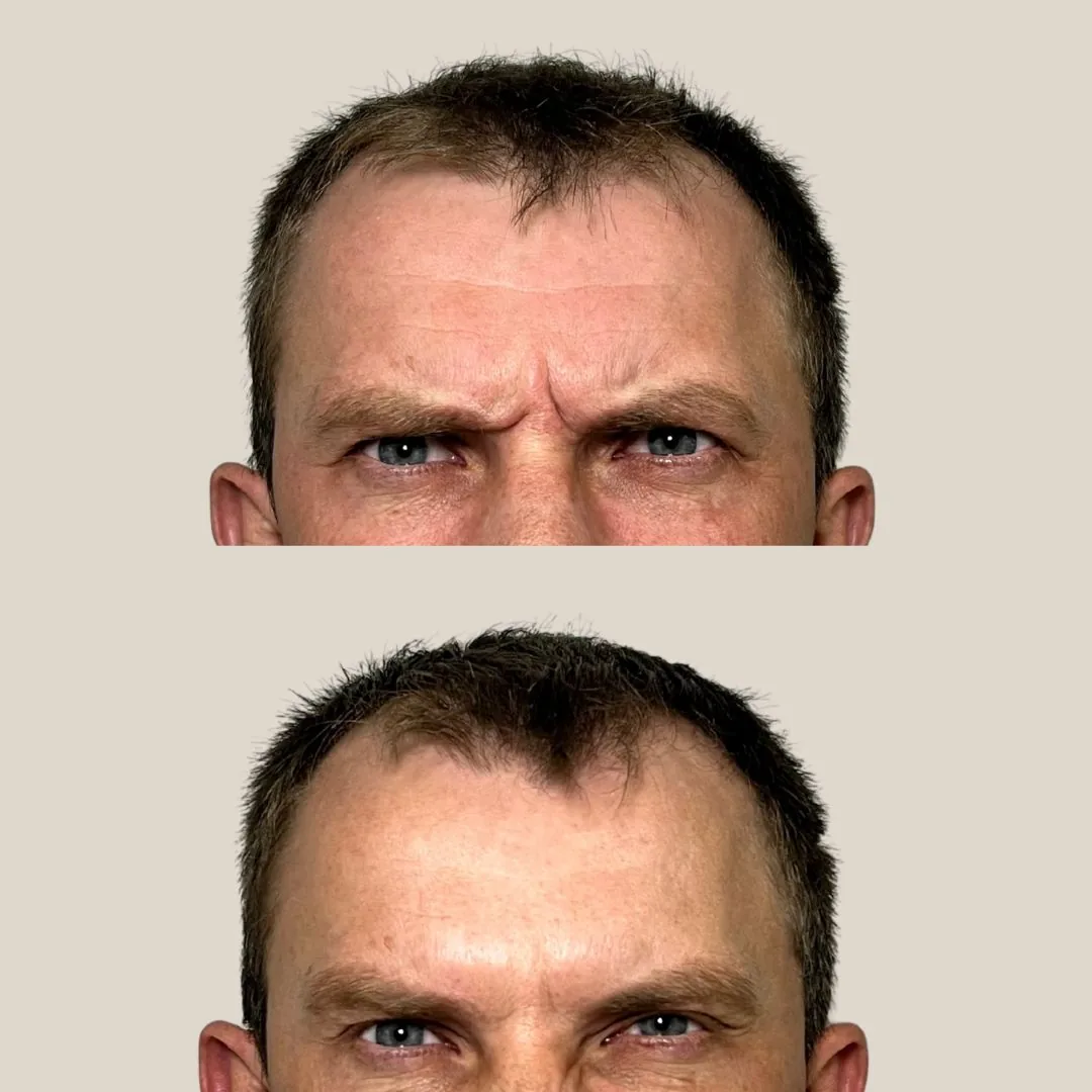 Botox - Pommerdent
