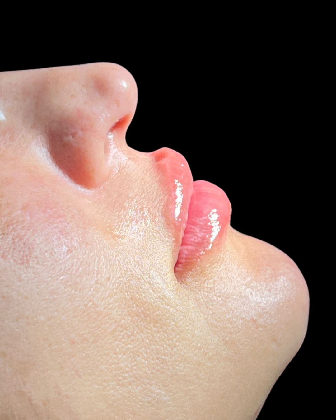 Depois Preenchimento