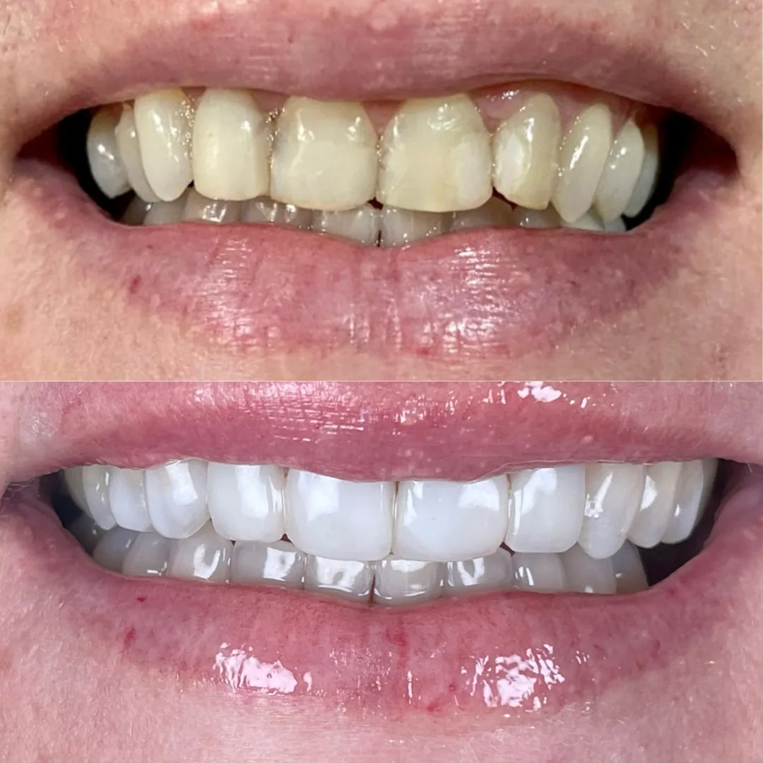 Lentes de Contato Dental
