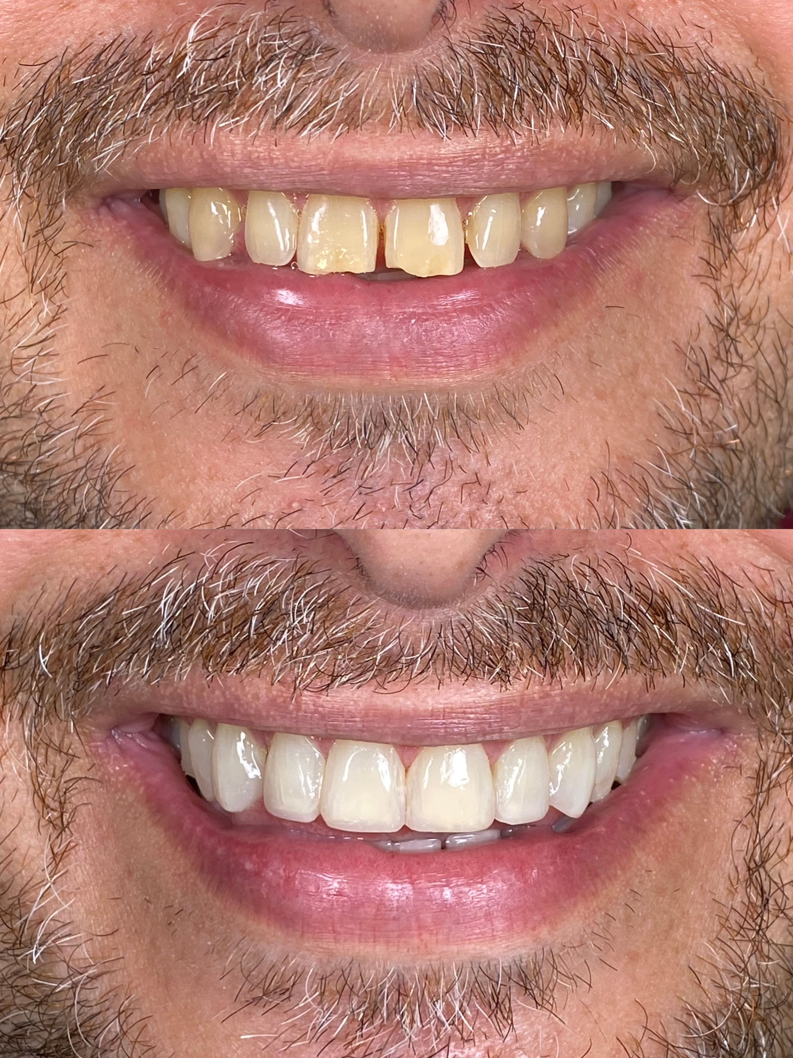 Transformação com Facetas - Pommerdent