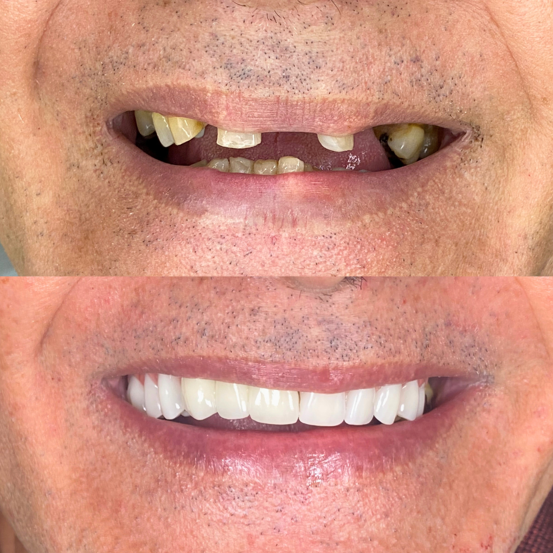 Prótese Parcial - Caso Clínico