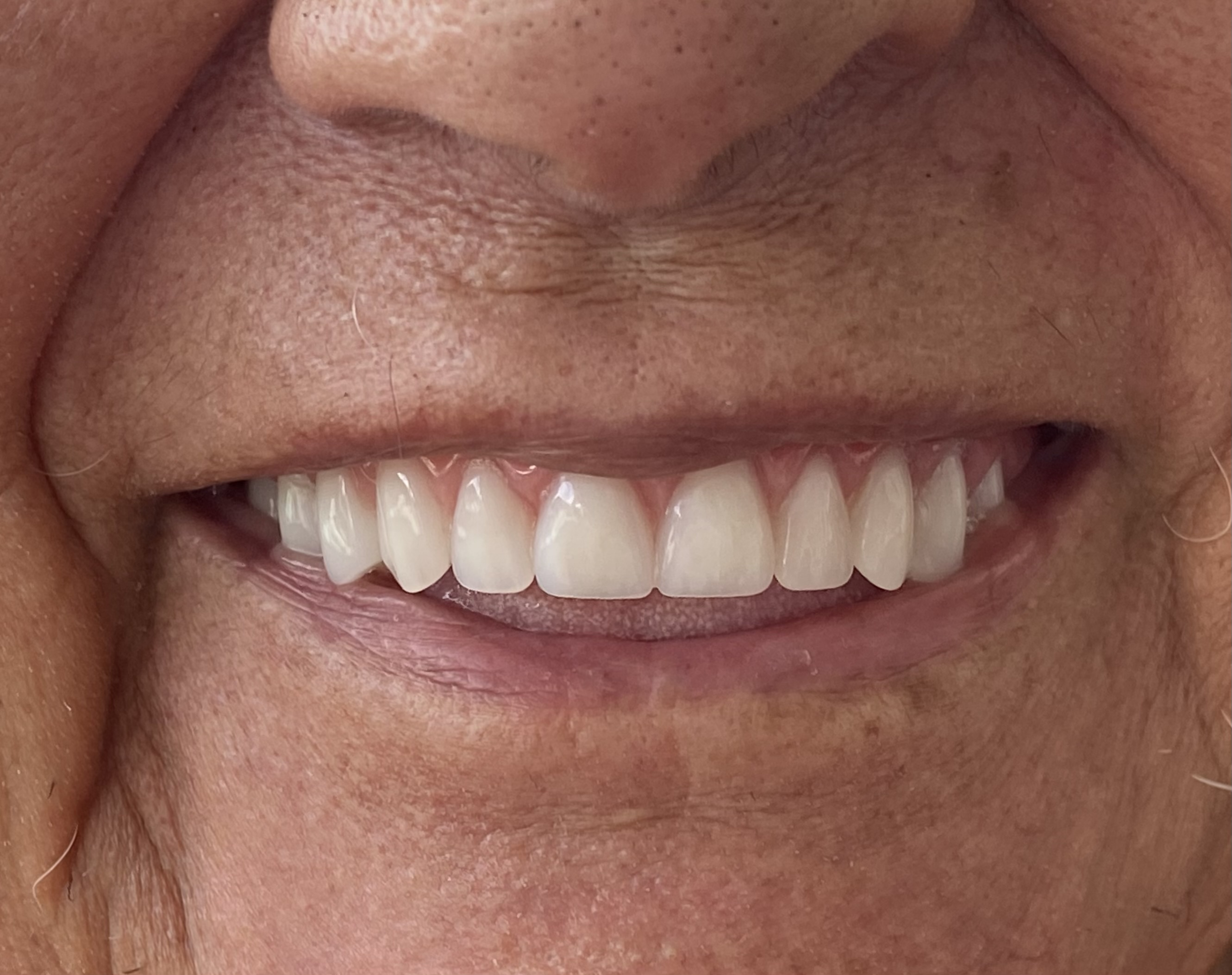 Prótese Dentária - Caso Clínico