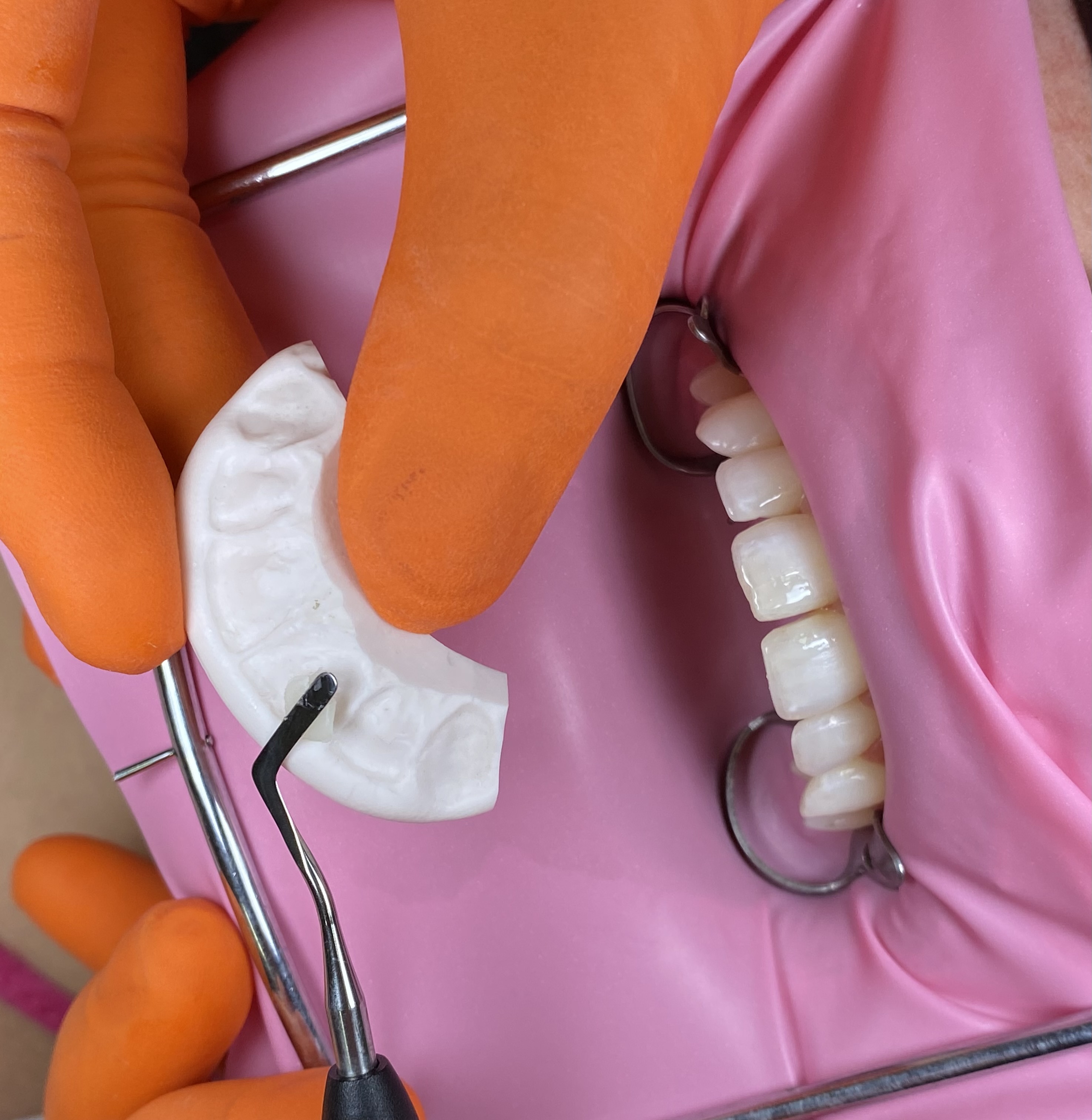 Resultado Estético - Pommerdent