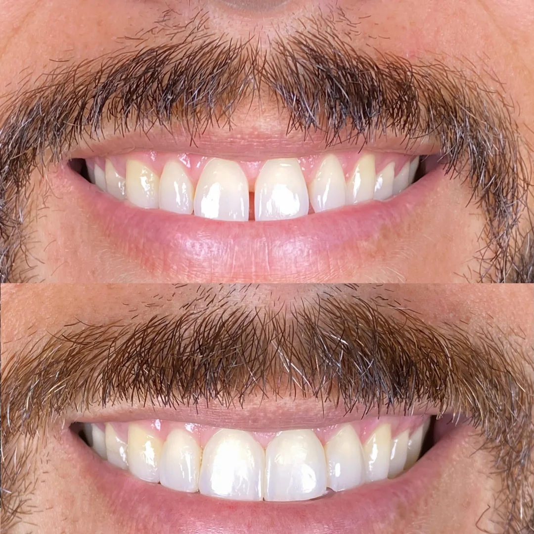 Harmonização Dental Resina