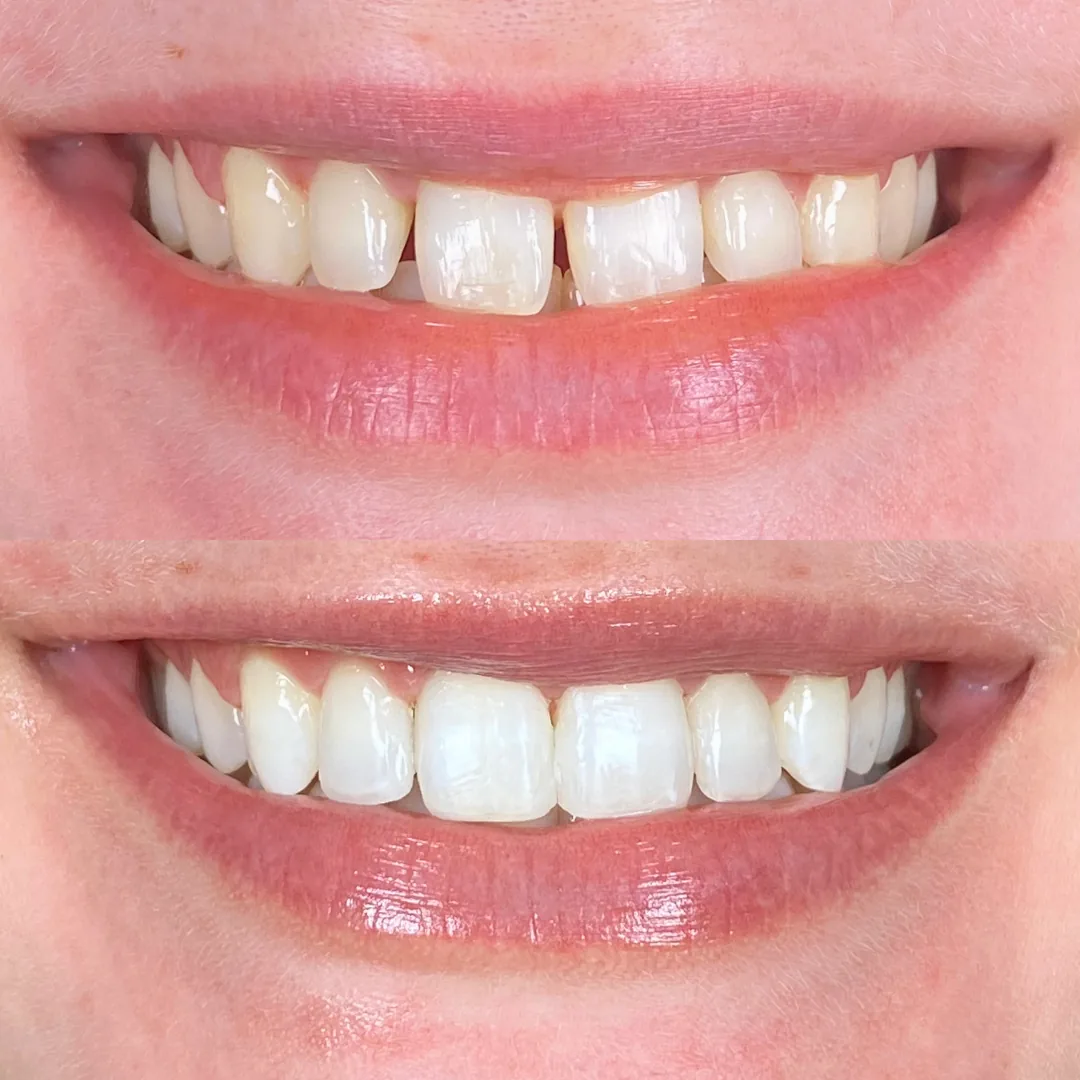 Estética Dental